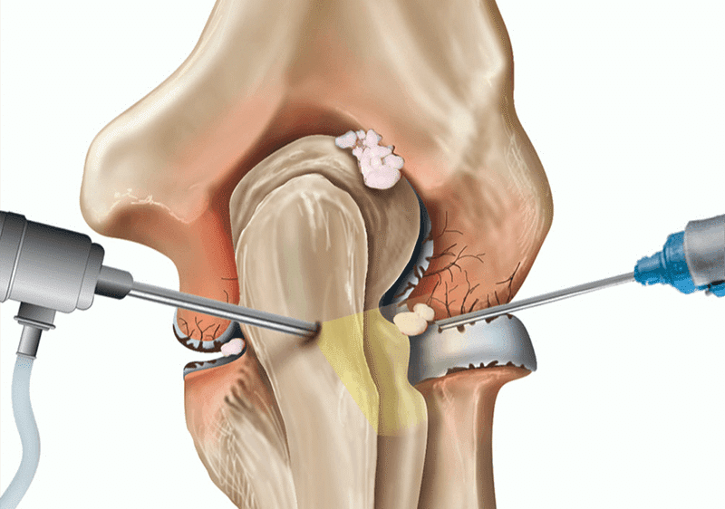 Artroskopi Nedir ?