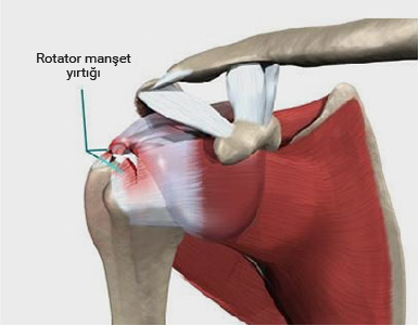Omuz Eklem Koruyucu Cerrahiler